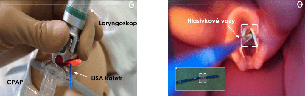 Česká Neonatologická Společnost • LISA Postup