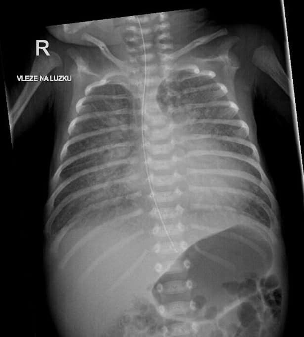 Česká Neonatologická Společnost • NeoQuiz Ventilace 3